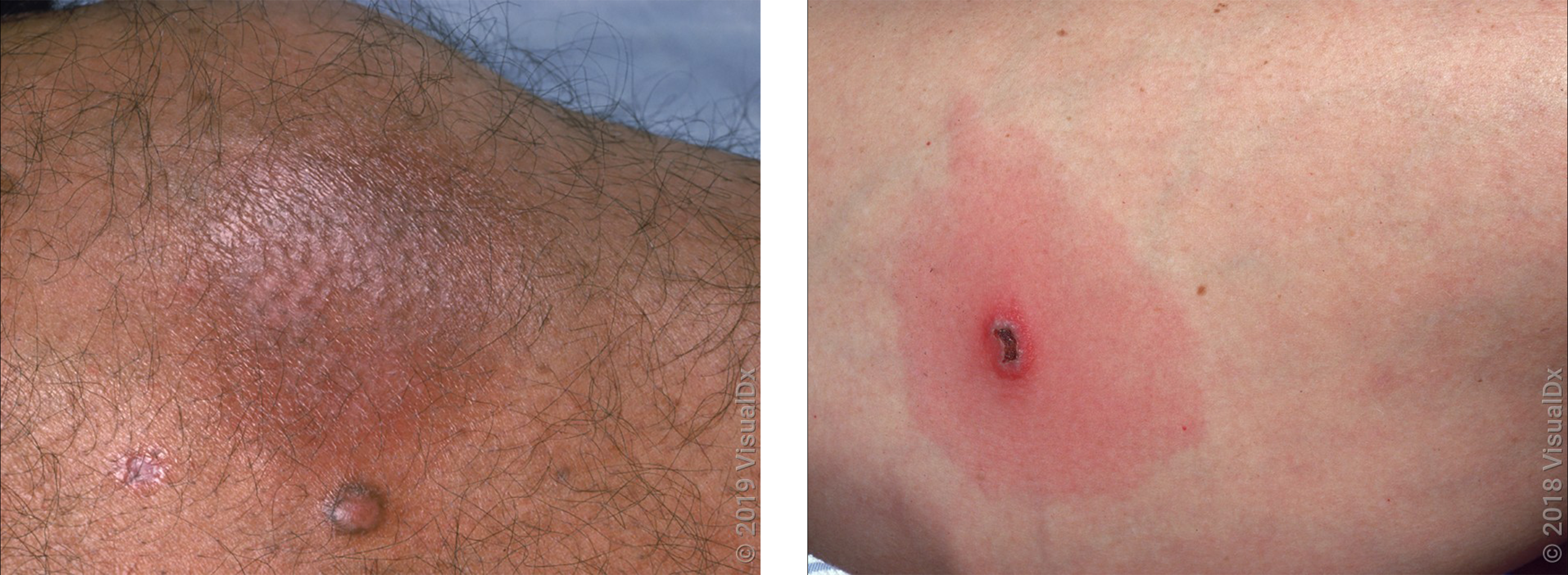 Left: Close-up of darker skin with a purple-brown round patch from a spider bite. Right: Close-up of skin with a round patch with different shades of red that looks like a bullseye rash.