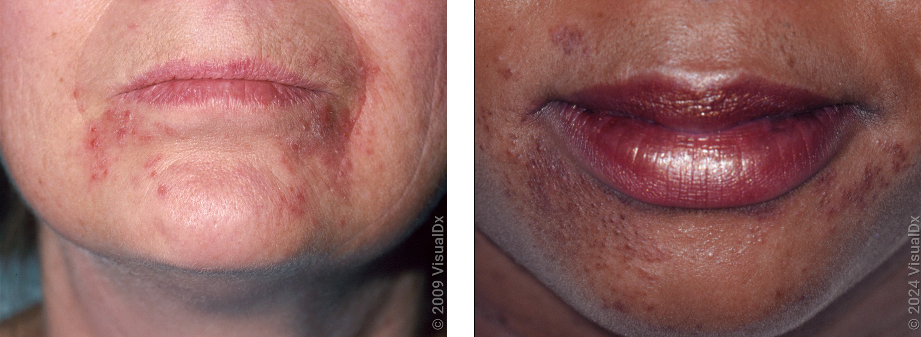 Left: Small, pink bumps and scaly patches around the mouth in perioral dermatitis. Right: Small, brown and purple bumps around the mouth in perioral dermatitis.