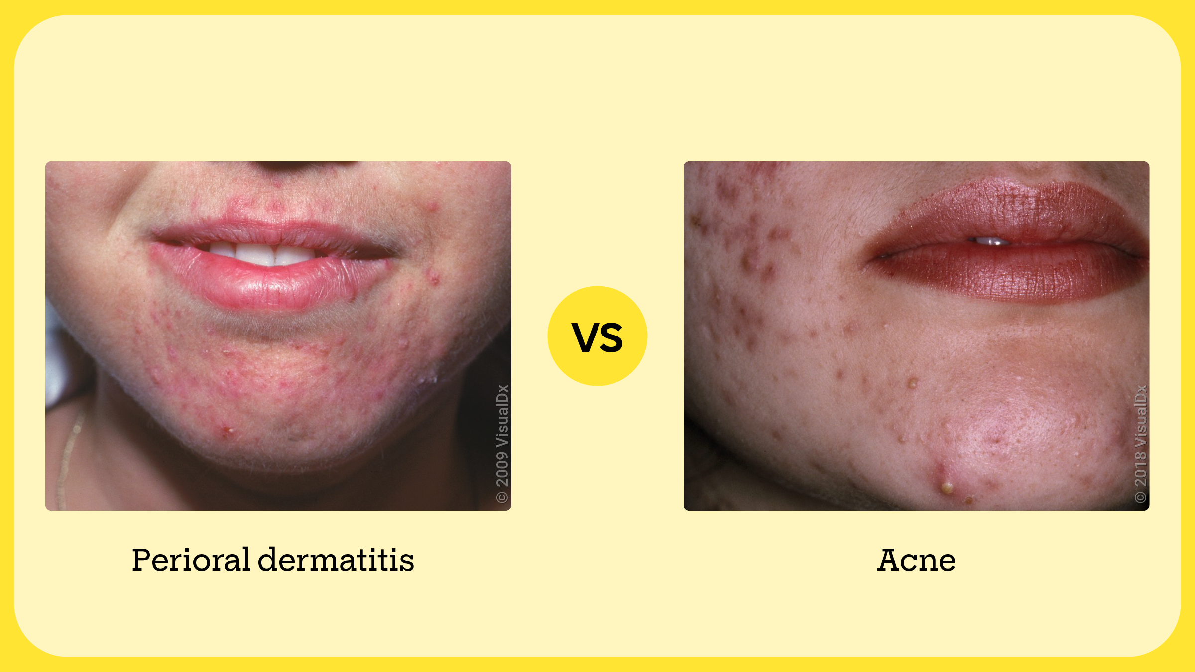 Left: Pink and red bumps around the mouth in perioral dermatitis. Right: Red pimples and comedones on the cheek and chin in acne.