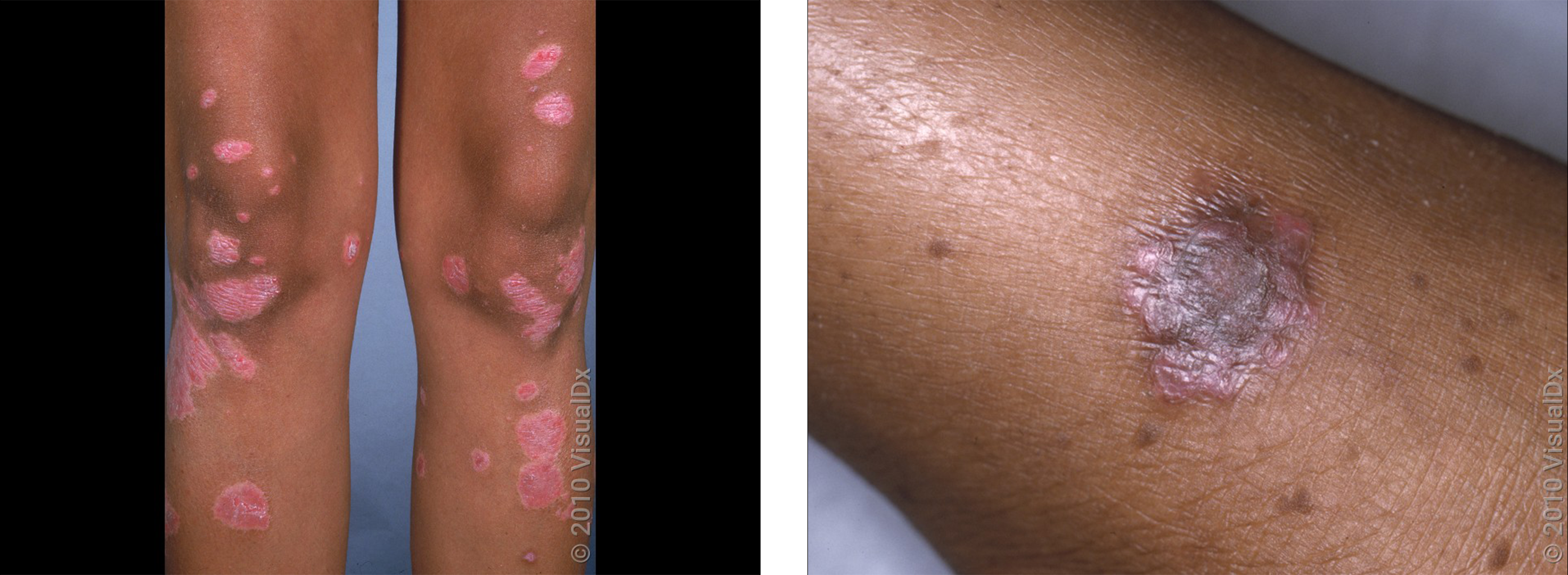Left: Pink, round patches on the legs in an autoimmune rash. Right: A close-up of a round, purple rash.