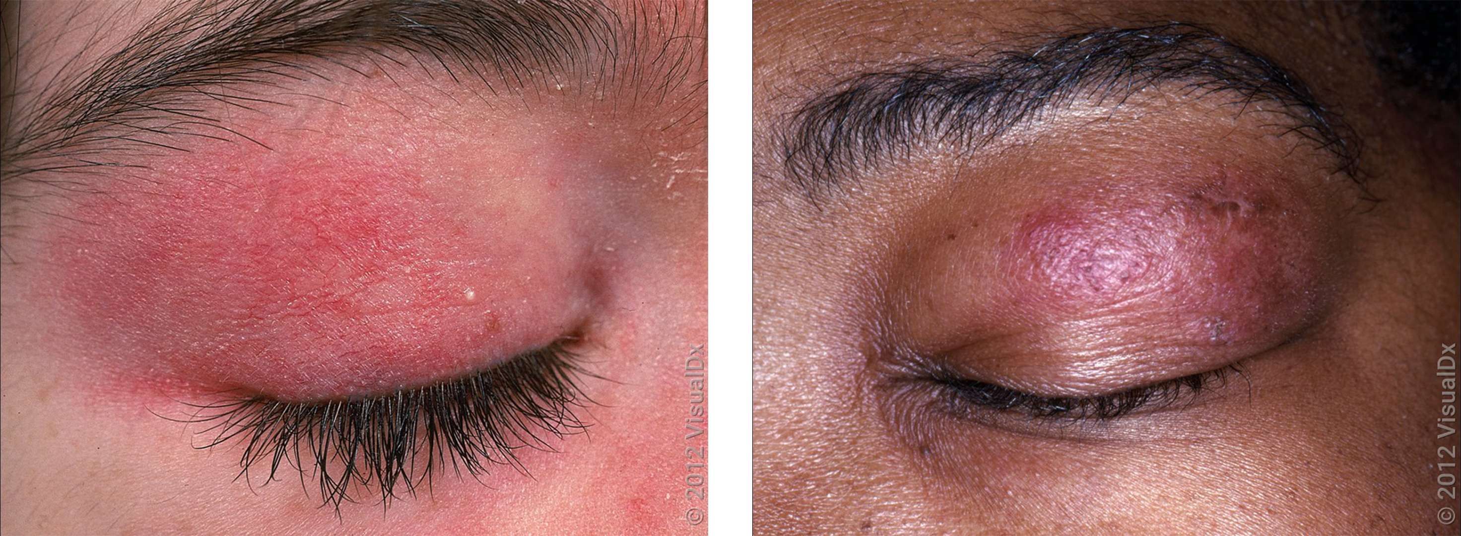 Left: Close-up of an eyelid with a red rash in dermatomyositis. Right: Close-up of an eyelid with a purple rash in dermatomyositis.