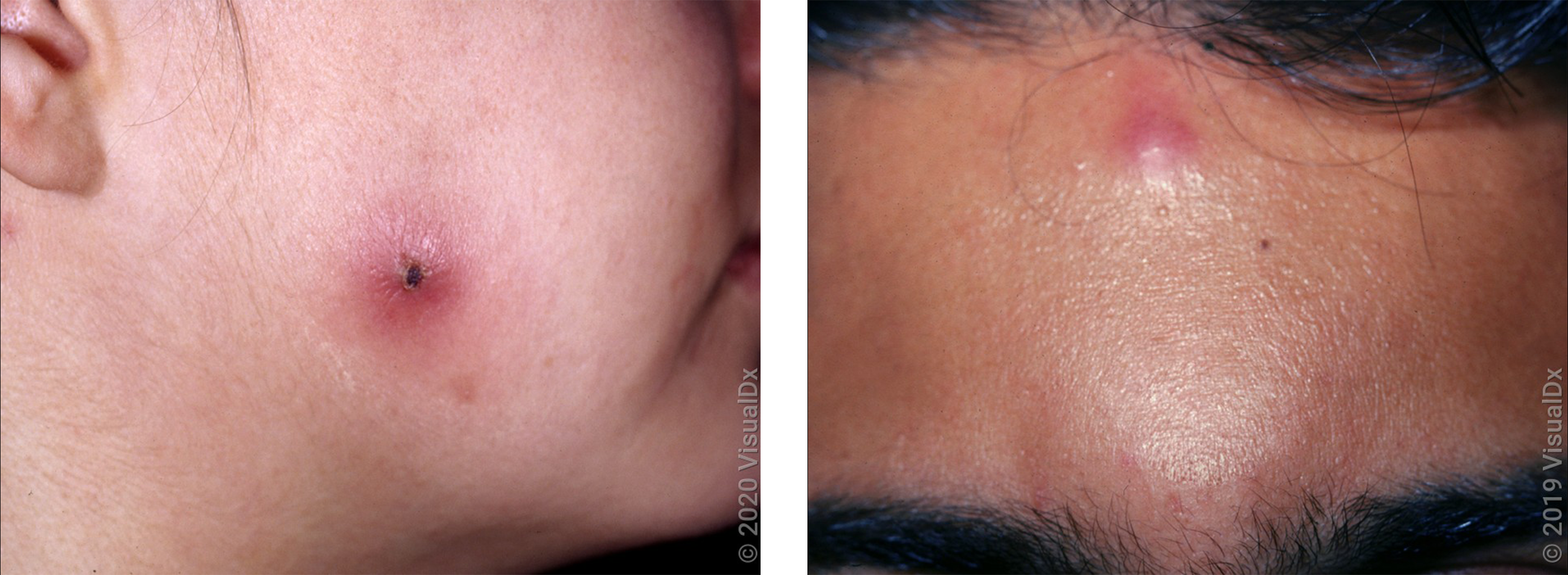 Left: Close-up of a cheek with a large, crusty, red bump from a spider bite. Right: A forehead with a smooth, shiny, red bump from a spider bite. 