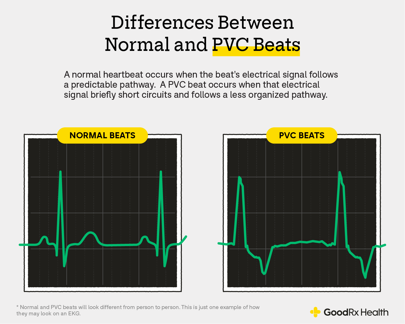 Infographic showing the differences between normal and PVC Beats