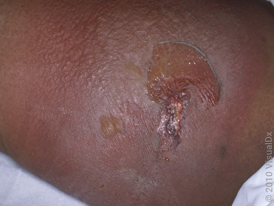 Close-up of skin with a violet-brown rash and a large blister.