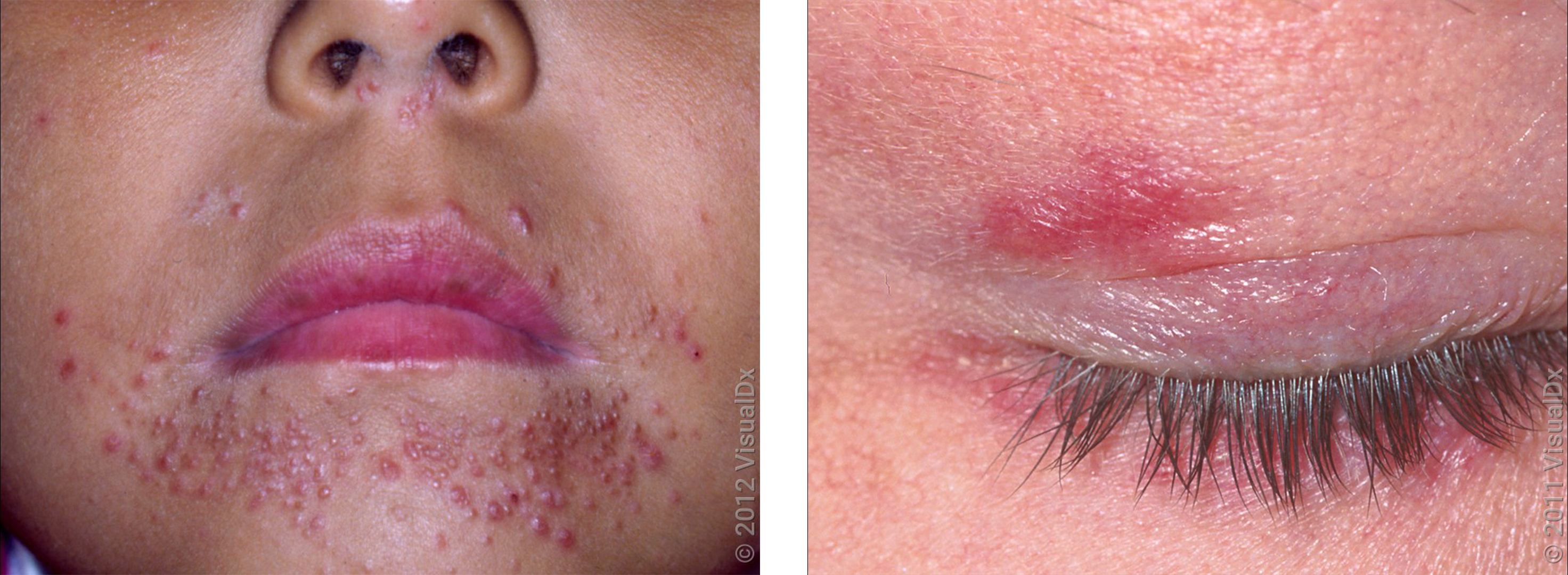 Left: Small, pink scaly bumps around the mouth and nose in perioral dermatitis. Right: Small, pink bumps on the upper eyelid in perioral dermatitis. 