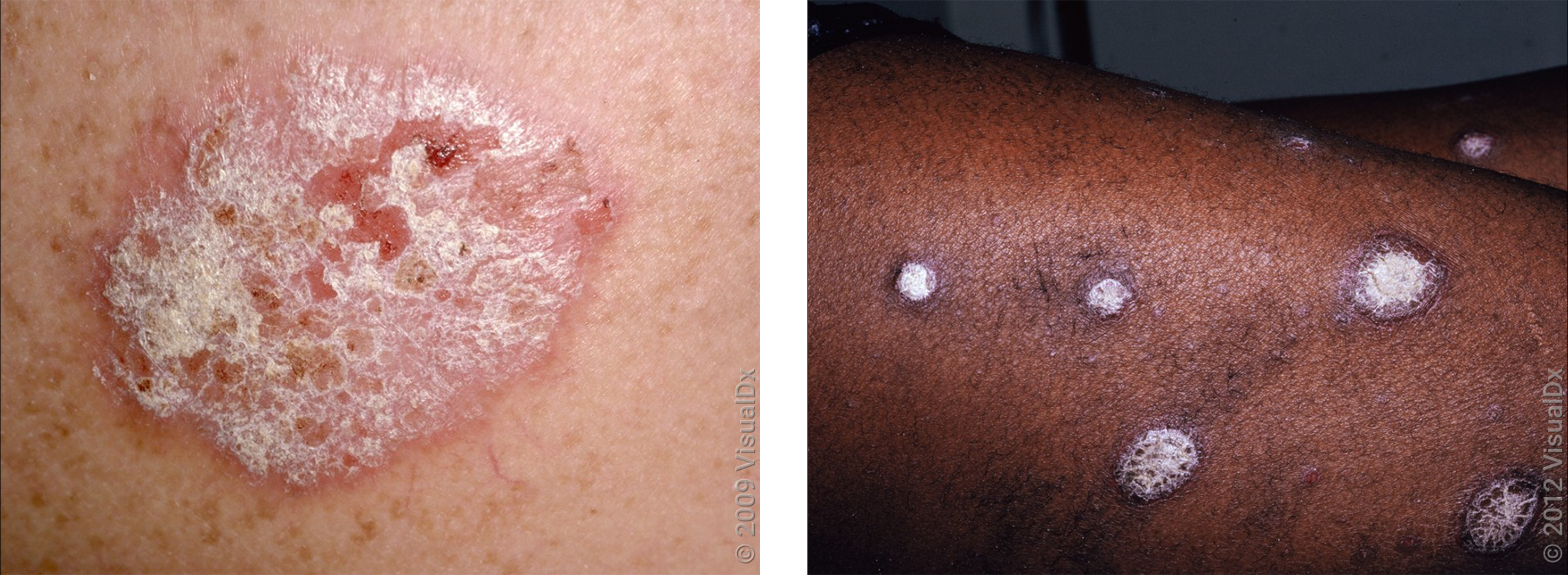 Left: A pink and scaly patch on the skin from psoriasis. Right: Thick, brown-violet round and scaly patches on the skin from psoriasis.