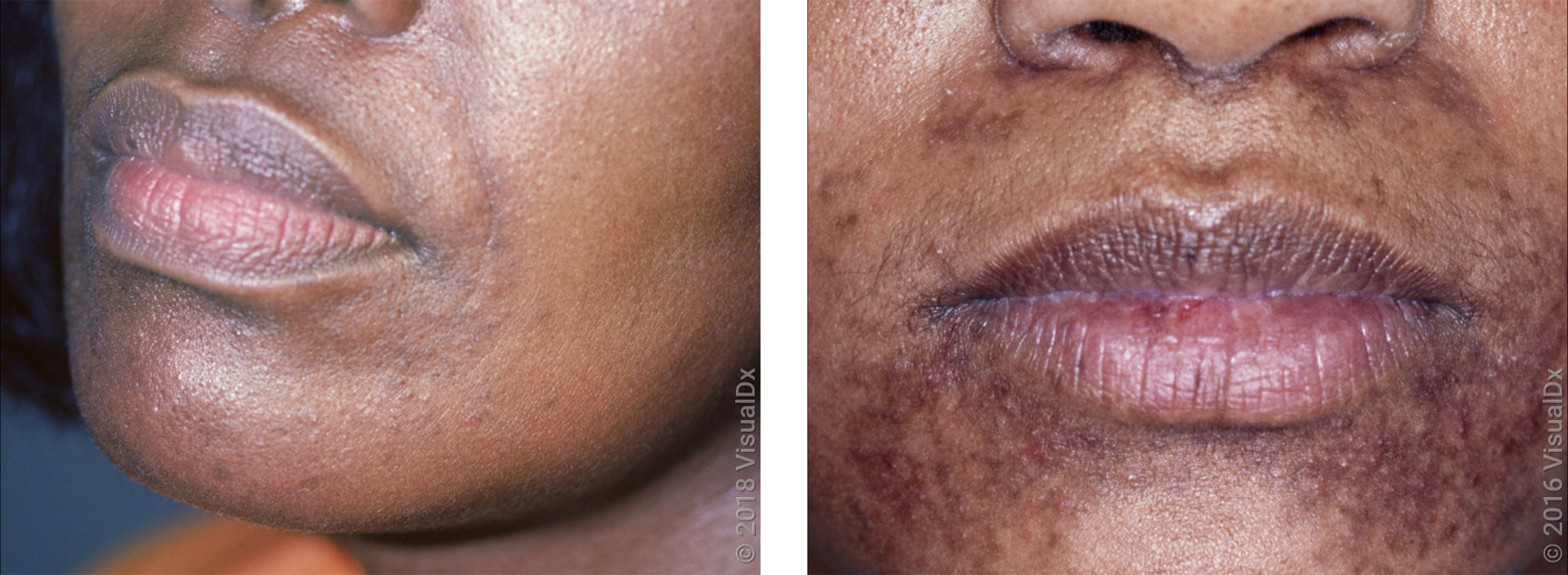 Left: Faint and small brown-purple bumps around the mouth in perioral dermatitis. Right: Small, violet and brown bumps around the mouth with some flat brown patches in perioral dermatitis.