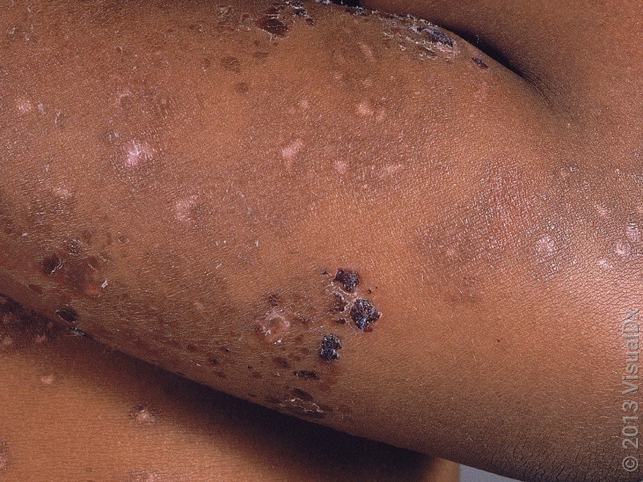 Crusts and white and dark skin patches on the arm in pemphigus. 