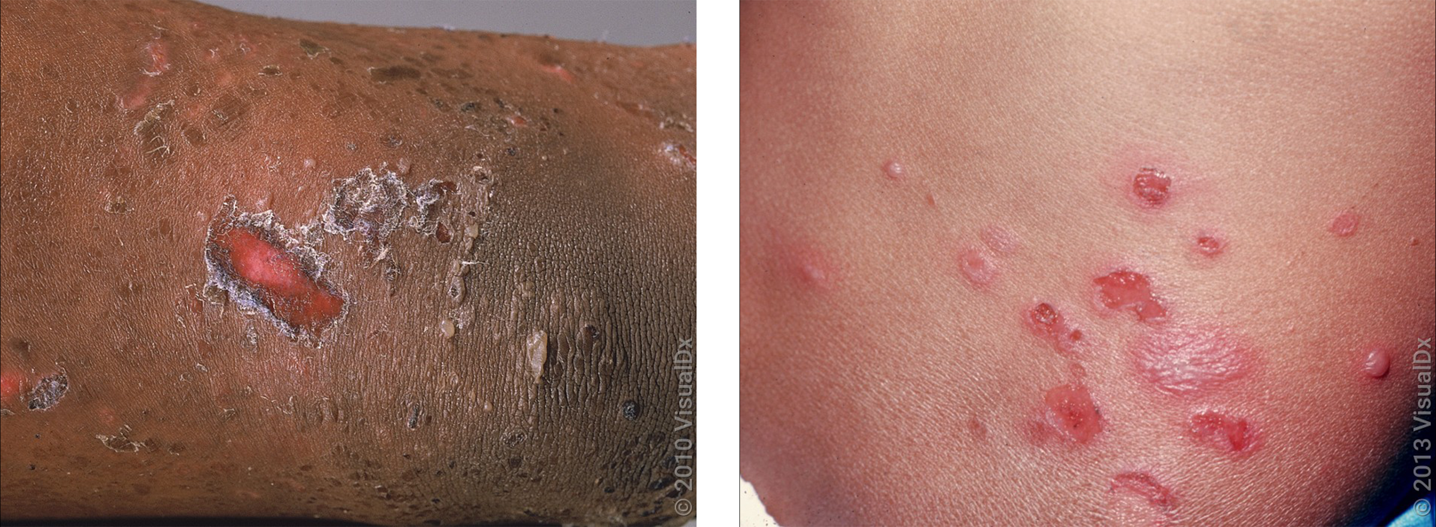 Left: An open sore and crusting on the skin. Right: Close-up of open sores on the skin.