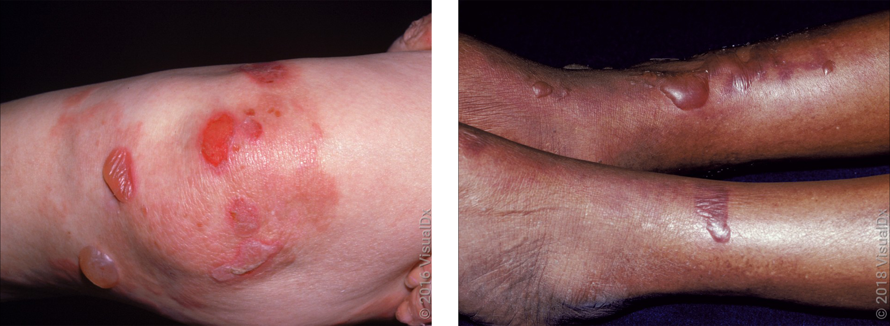 Left: Large blisters, sores, and red patches on the knee in autoimmune pemphigoid. Right: Large, fluid-filled blisters on both legs with a purple rash in autoimmune pemphigoid. 