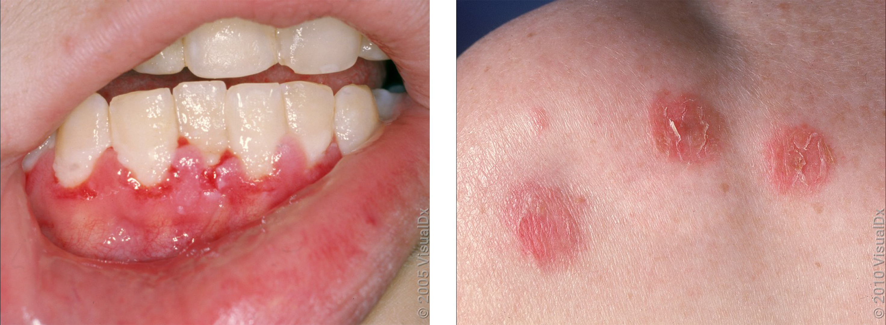 Left: Open sores in the mouth around the gumline in pemphigus. Right: Pink crusty patches  on the shoulder in pemphigus.