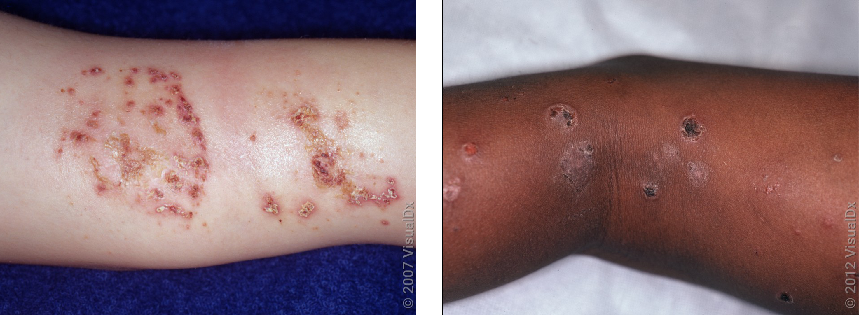 Left: Open sores and crusts on the arm. Right: Several round crusts on the skin.