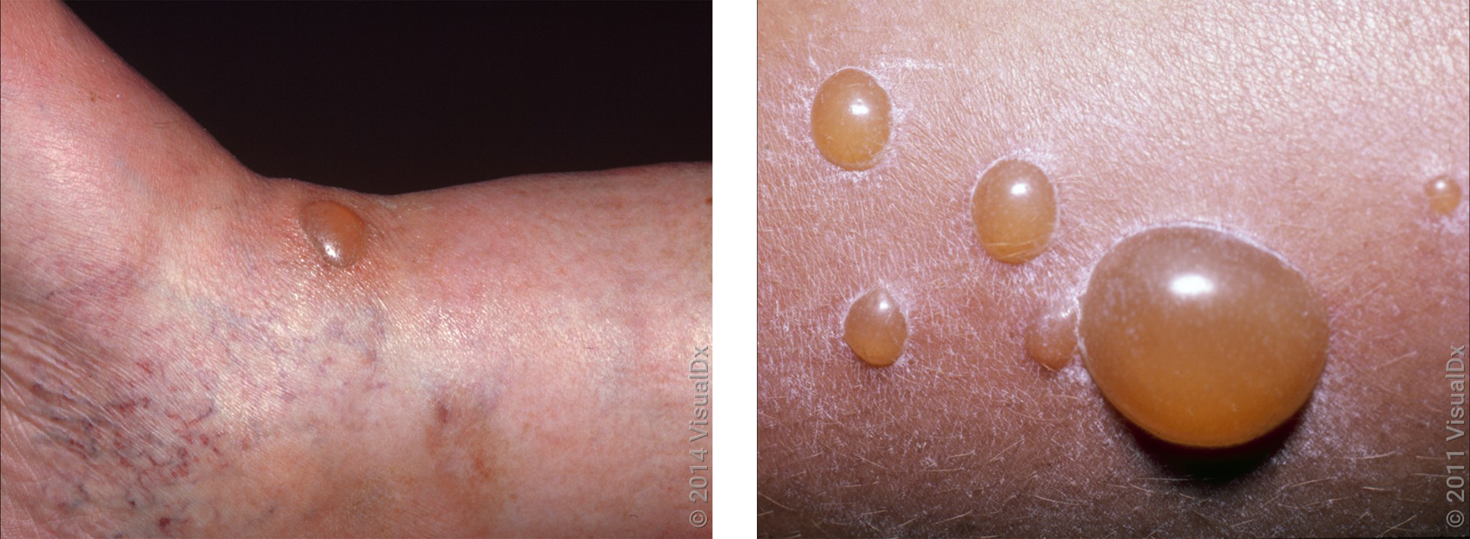 Left: A small, white blister on the skin. Right: Large blisters on the skin in an autoimmune rash.