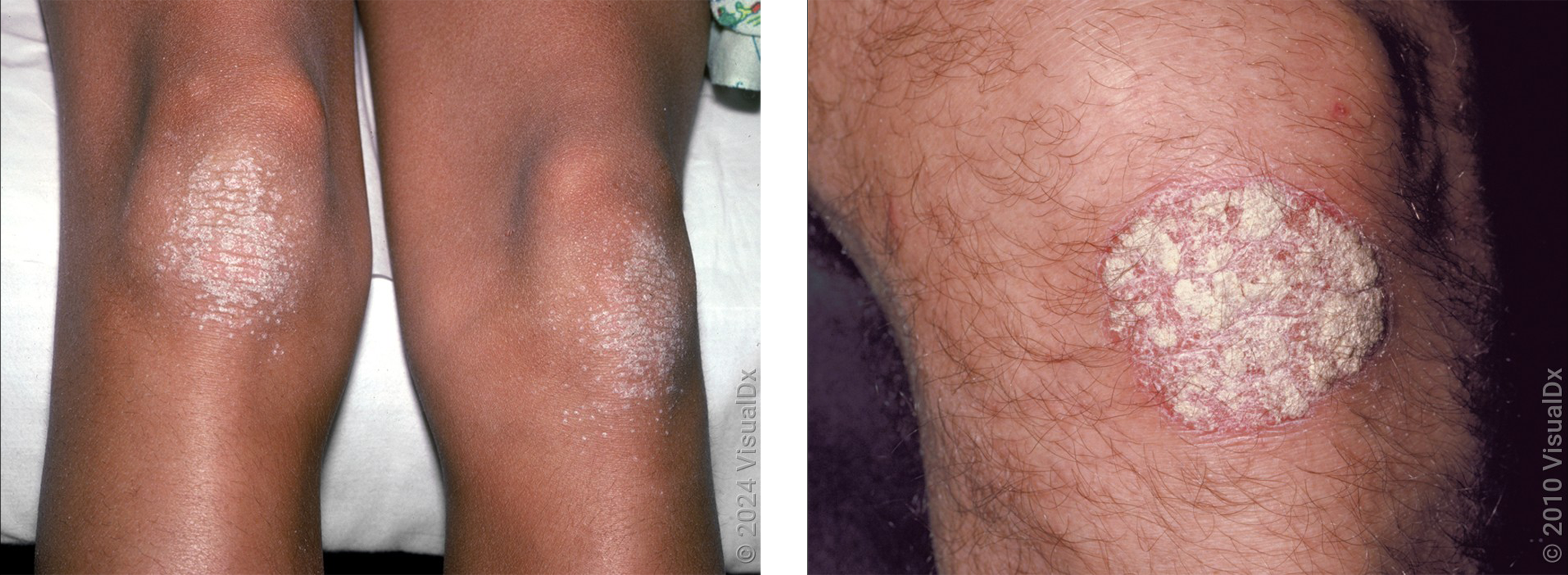 Left: Many round, white-gray scaly patches on the skin in an autoimmune rash. Right: A white, round patch on the skin in an autoimmune rash.