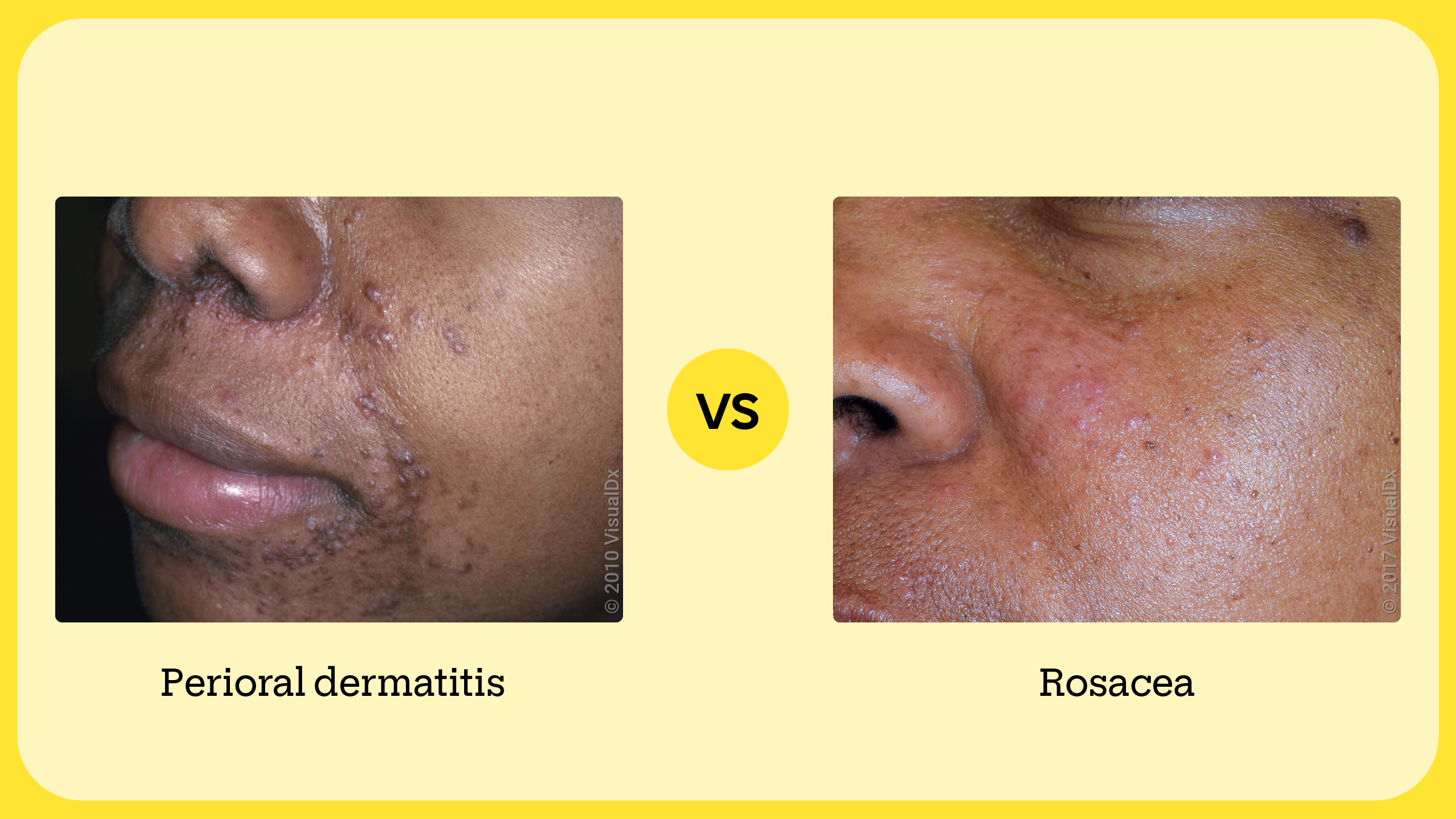 Left: Brown and violet bumps around the mouth and nose in perioral dermatitis. Right: Pink bumps on the cheek in rosacea.
