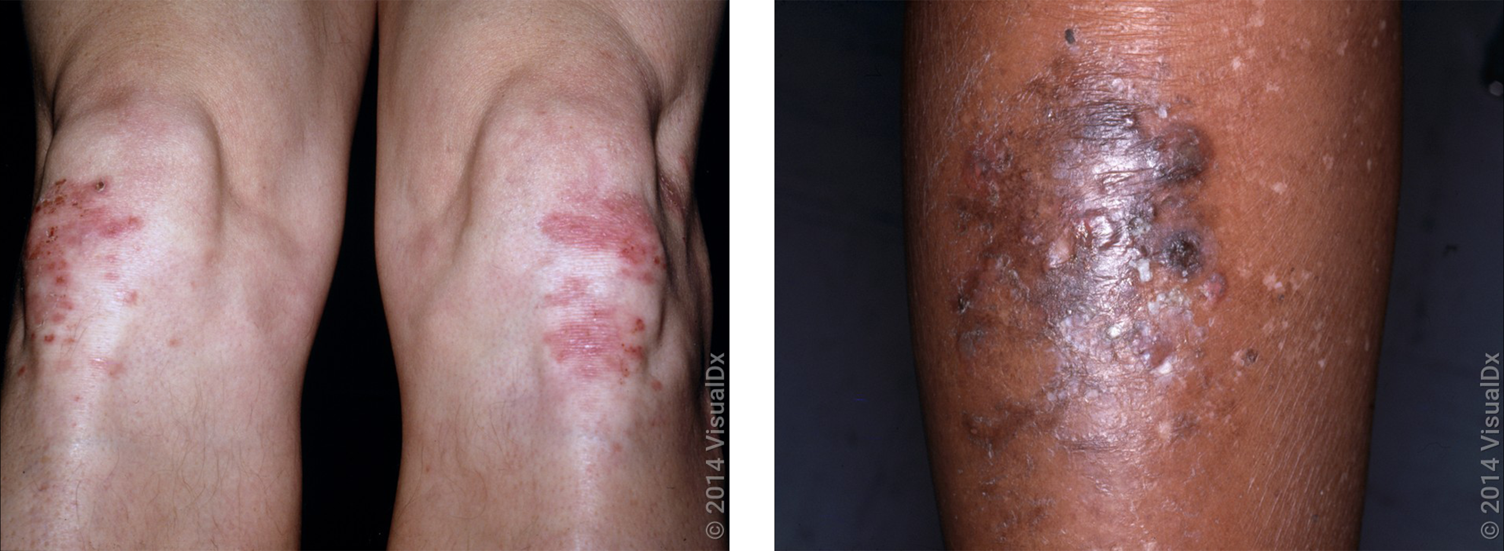 Left: Pink sores and crusts on the knees in autoimmune dermatitis herpetiformis. Right: Close-up of blisters and dark patches on the shin rm in autoimmune dermatitis herpetiformis.