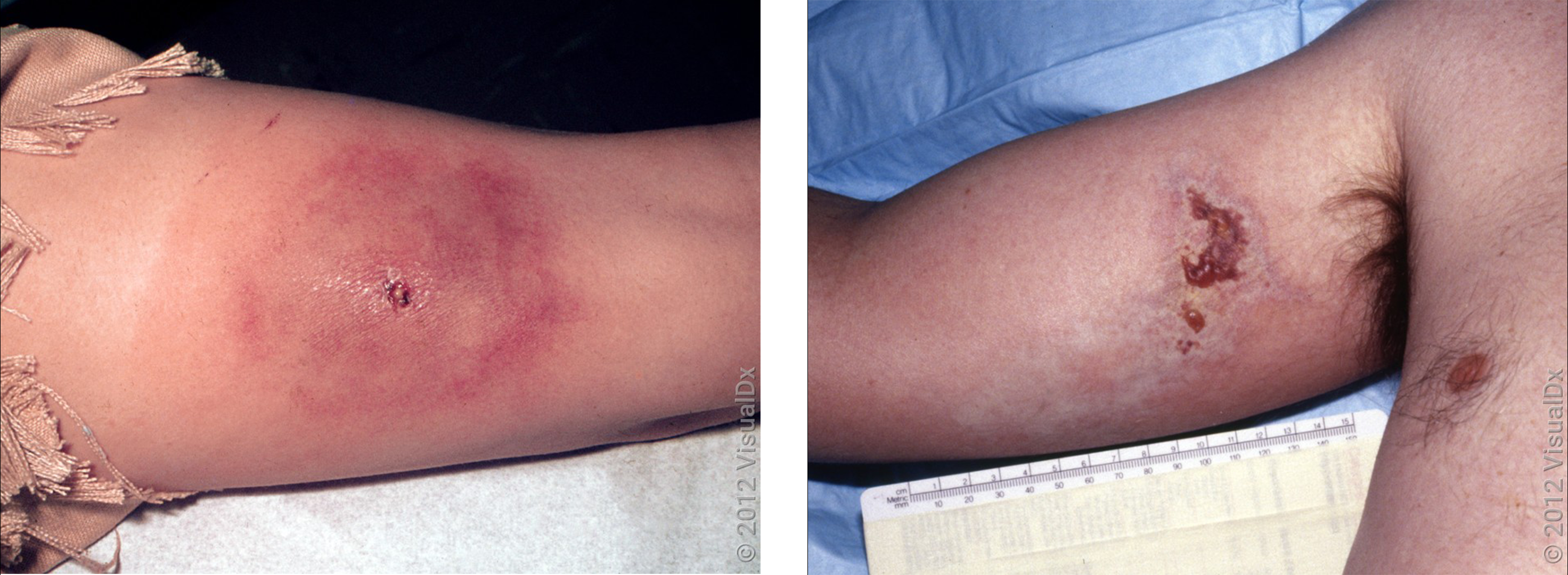 Left: Crust and blood with surrounding purple discoloration from a spider bite on the thigh.  Right: An open wound with surrounding red skin on the arm from a spider bite. 