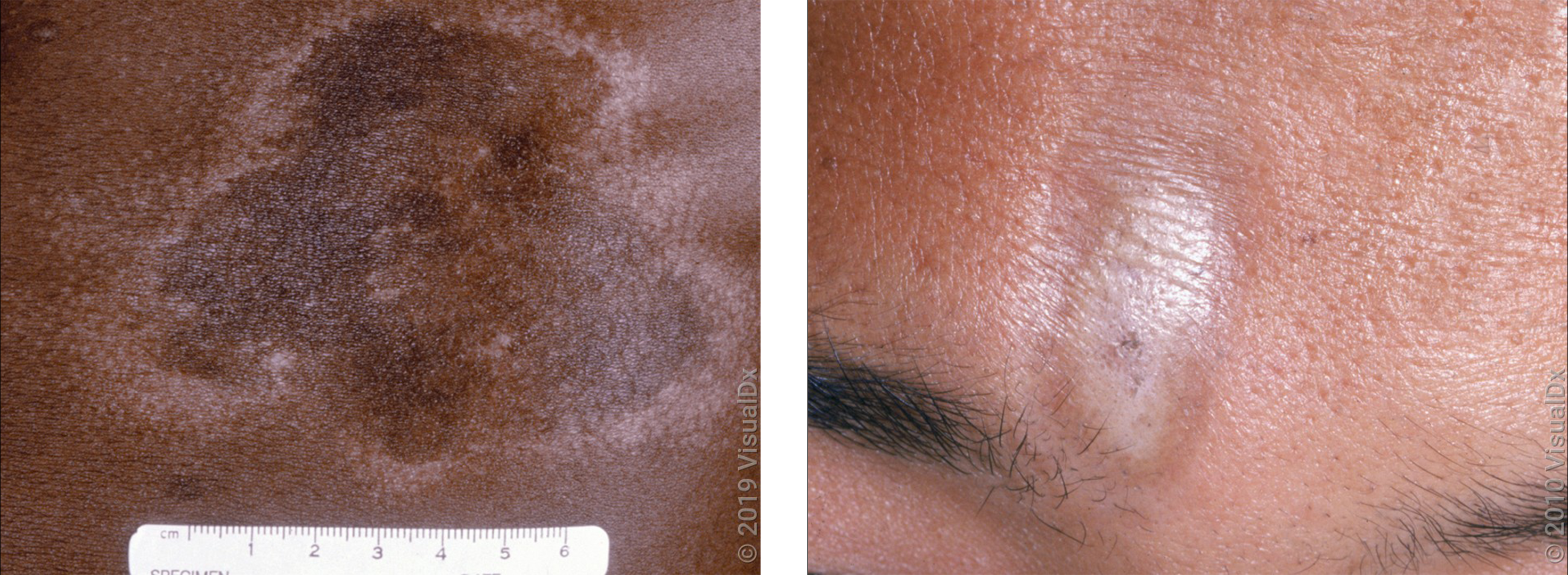 Left: Close-up of a brown and white patch on the skin in morphea. Right: A shiny white patch on the forehead in morphea.