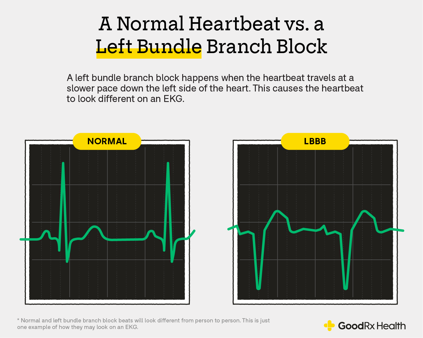 Infographic showing the differences between a normal beat and a left bundle branch block.