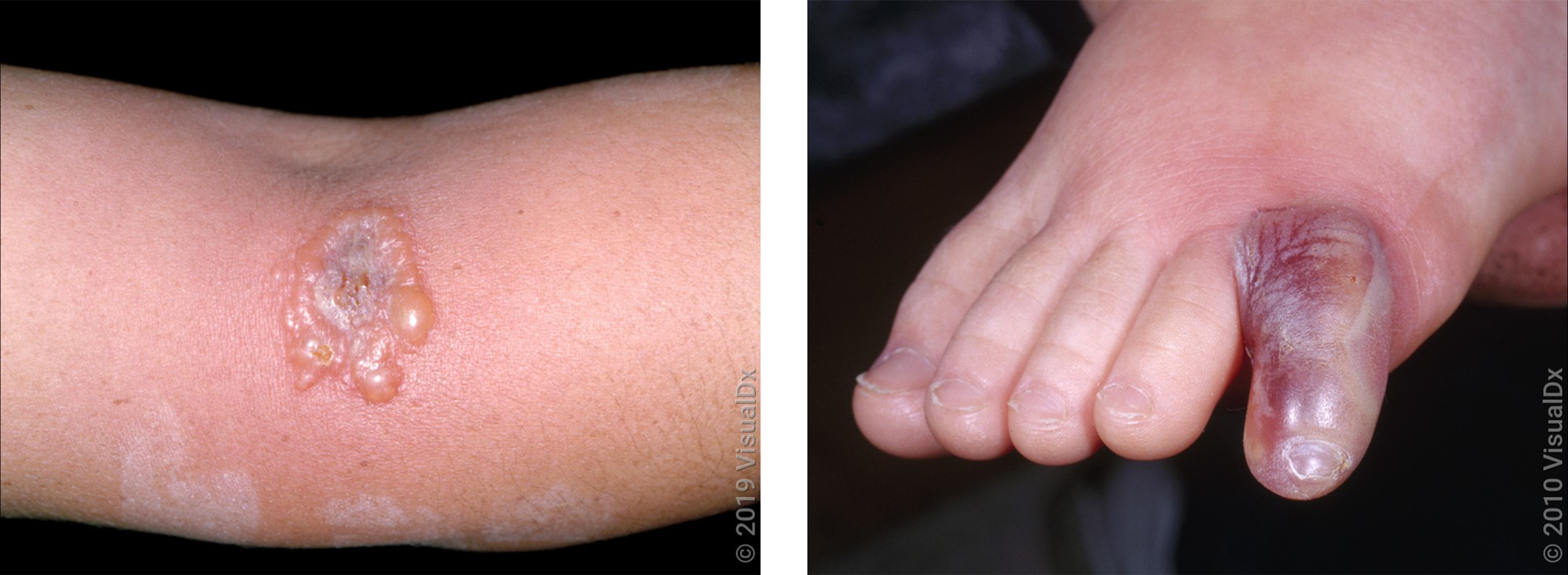 Left: An arm with a red rash that has blisters and some swelling. Right: Close-up of a toe covered in a bloody blister.