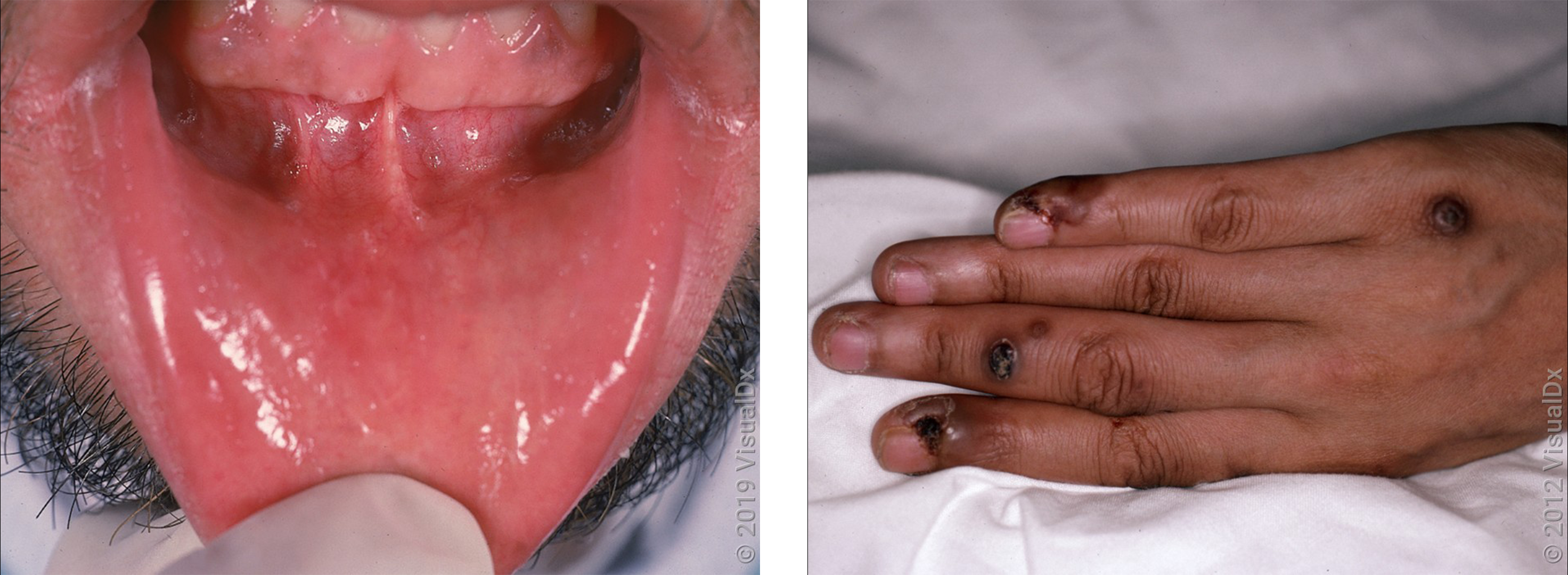 Left: Sores on the inner lower lip in Behçet disease. Right: Blisters and brown crusty patches on the hand in Behçet disease.