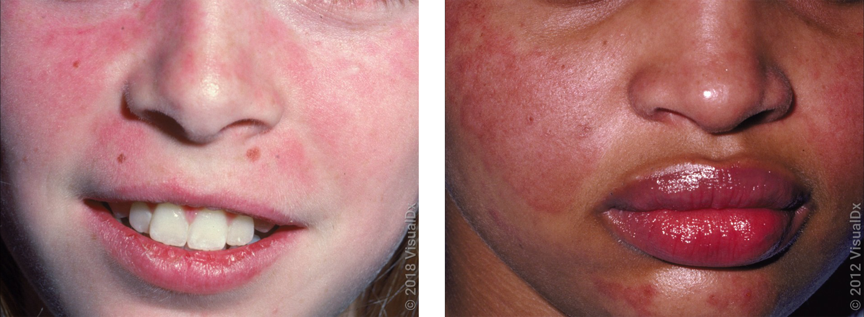 Left: A pink rash on the nose, cheeks, and upper lip in lupus. Right: A red faint  purple rash on the nose and cheeks in lupus.