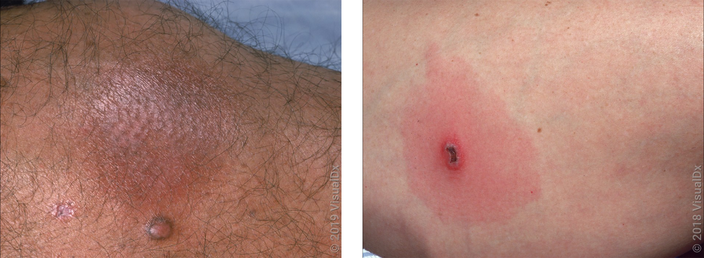 Left: Close-up of darker skin with a purple-brown round patch from a spider bite. Right: Close-up of skin with a round patch with different shades of red that looks like a bullseye rash.