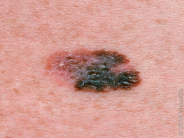 Close-up of a melanoma on lighter skin. 