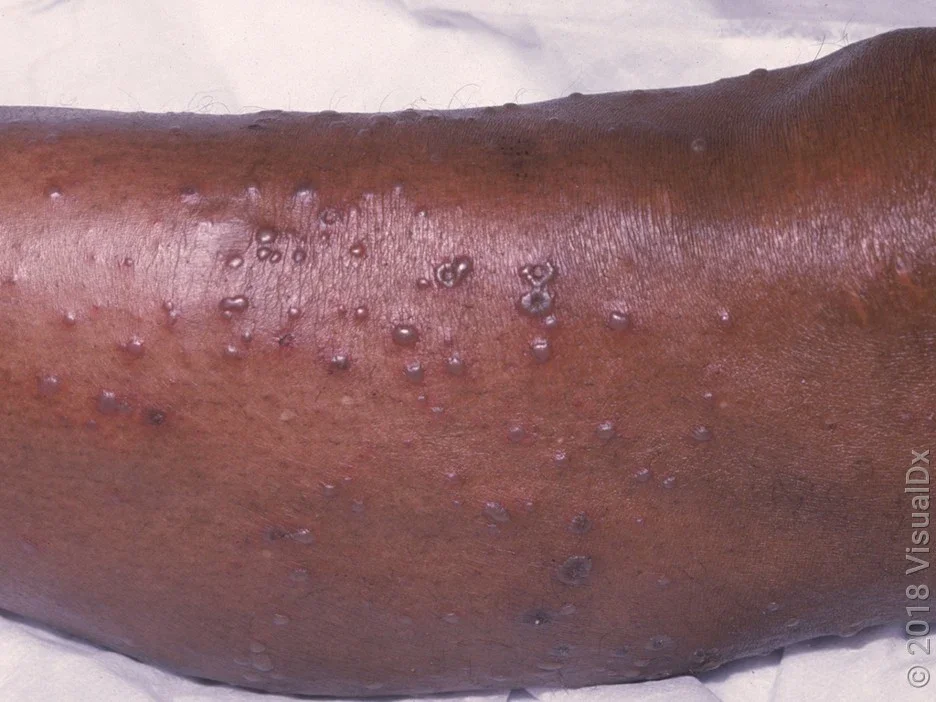 A leg with many blisters caused by chickenpox. 