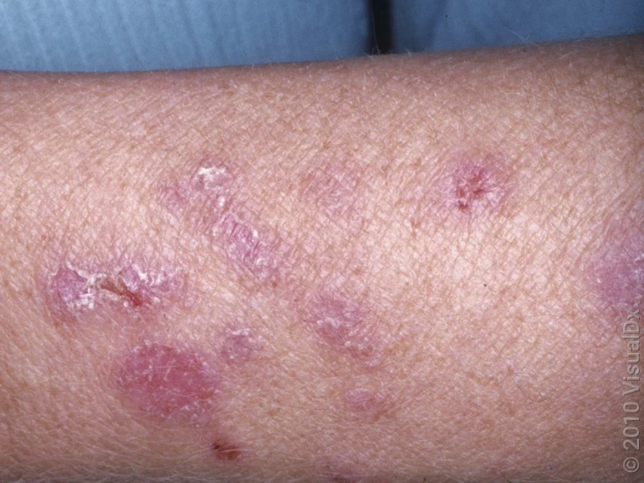 Discoid lupus rash on the arm. 