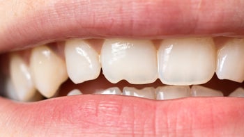Health: Dental care: close up white teeth-1313472228