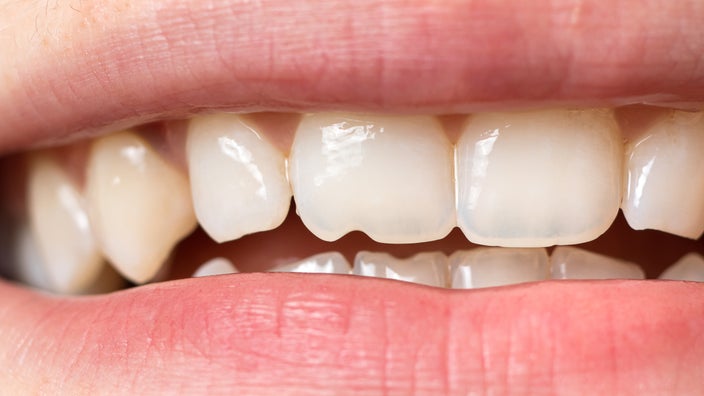 White Strips Burning Gums