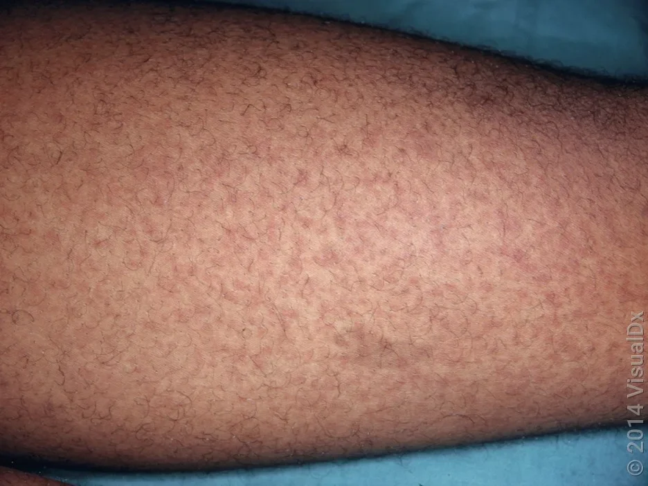 Close-up of a leg with the mono rash.