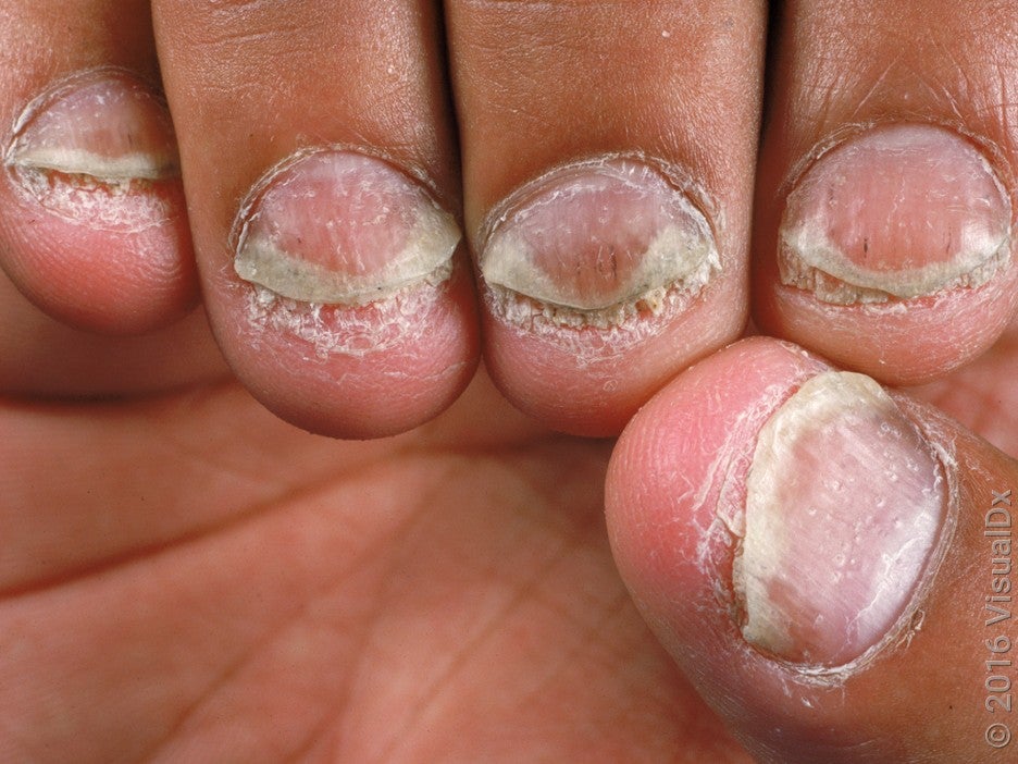 8 Ways Psoriatic Arthritis Affects the Nails GoodRx