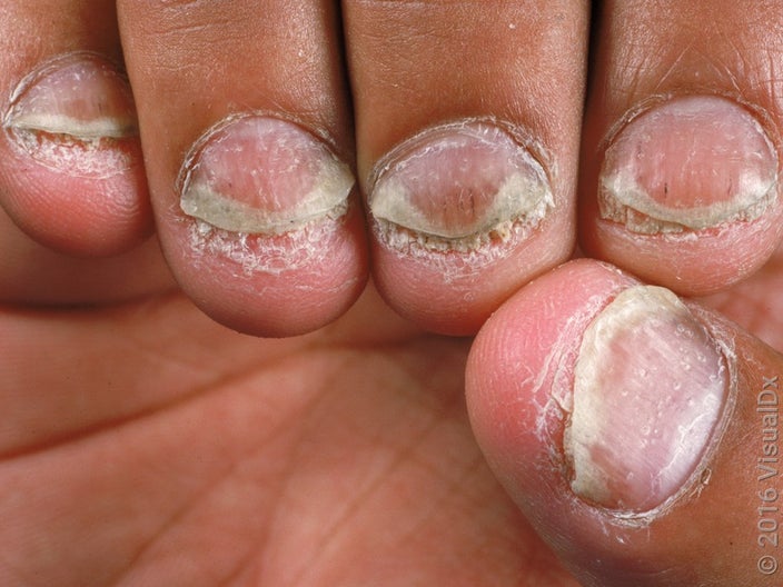 Close-up of fingernails that have thick patches underneath the nail tip (nail psoriasis).  
