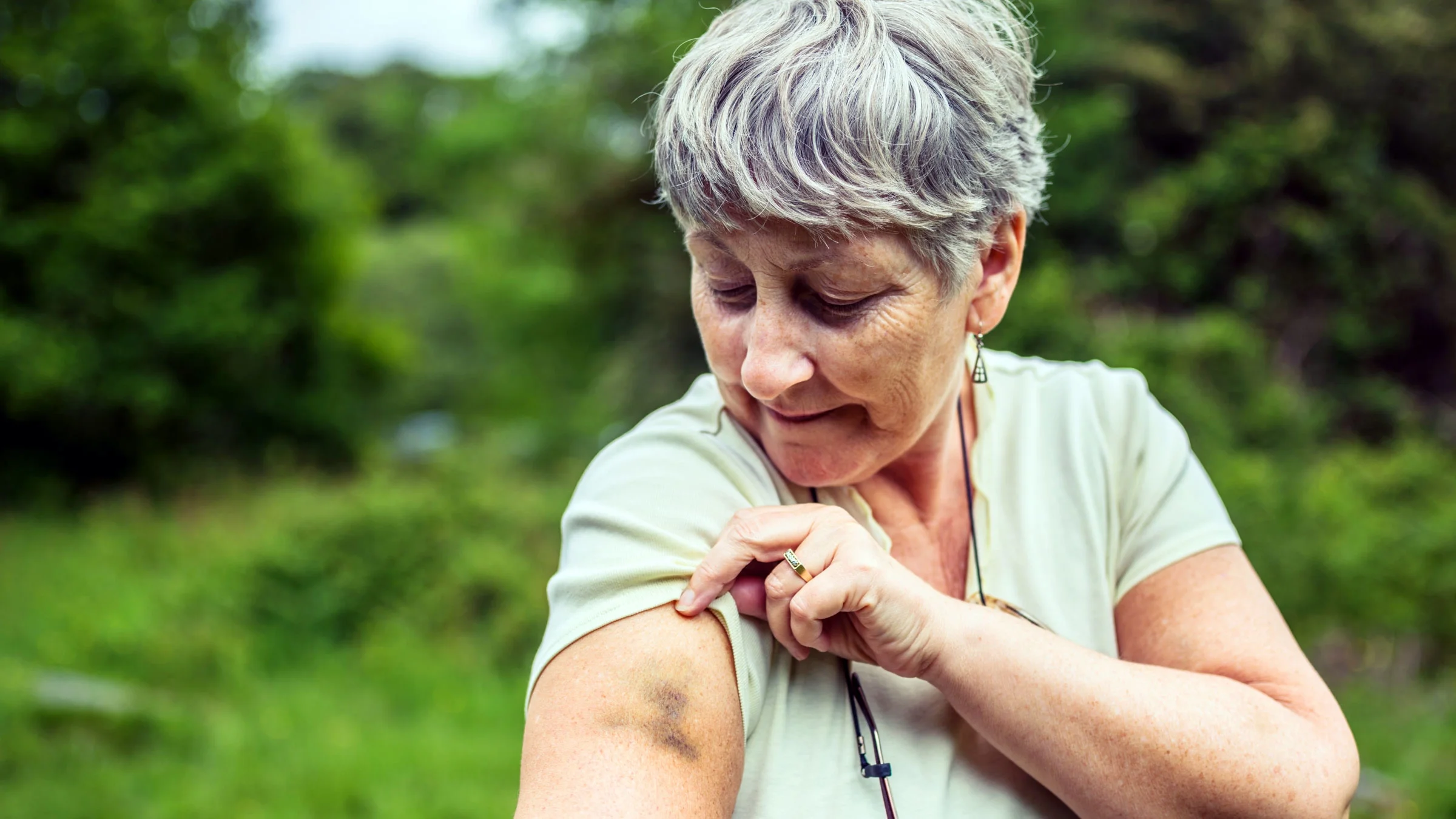 A woman is outside looking at a bruise on her arm.