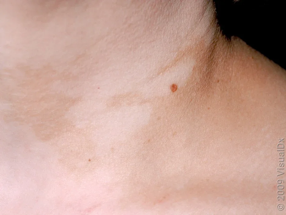 Close-up of vitiligo on fair skin on the neck.
