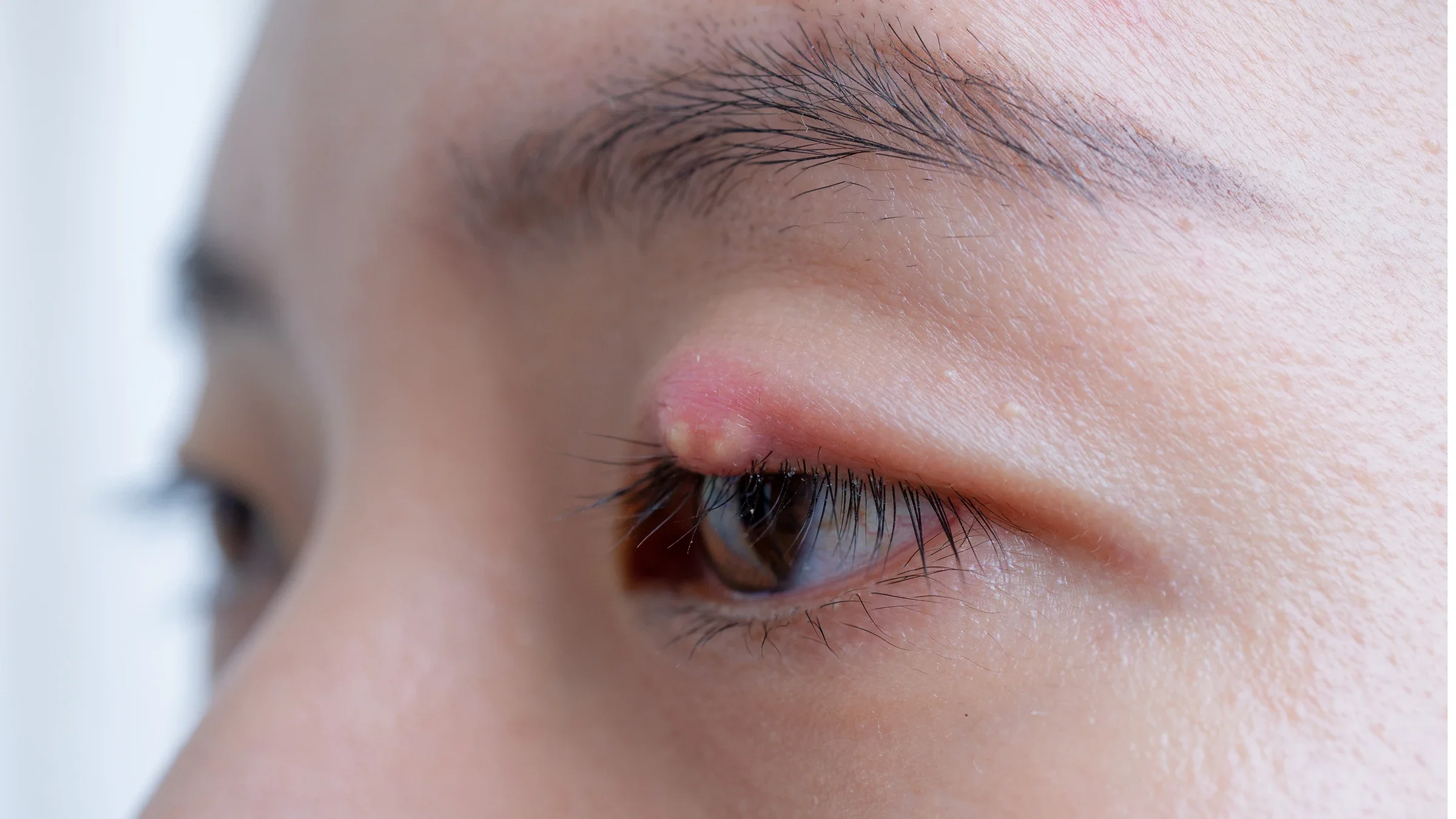 A close-up shot of a person with a cyst or growth on their eyelid.
tampatra/iStock via Getty Images
