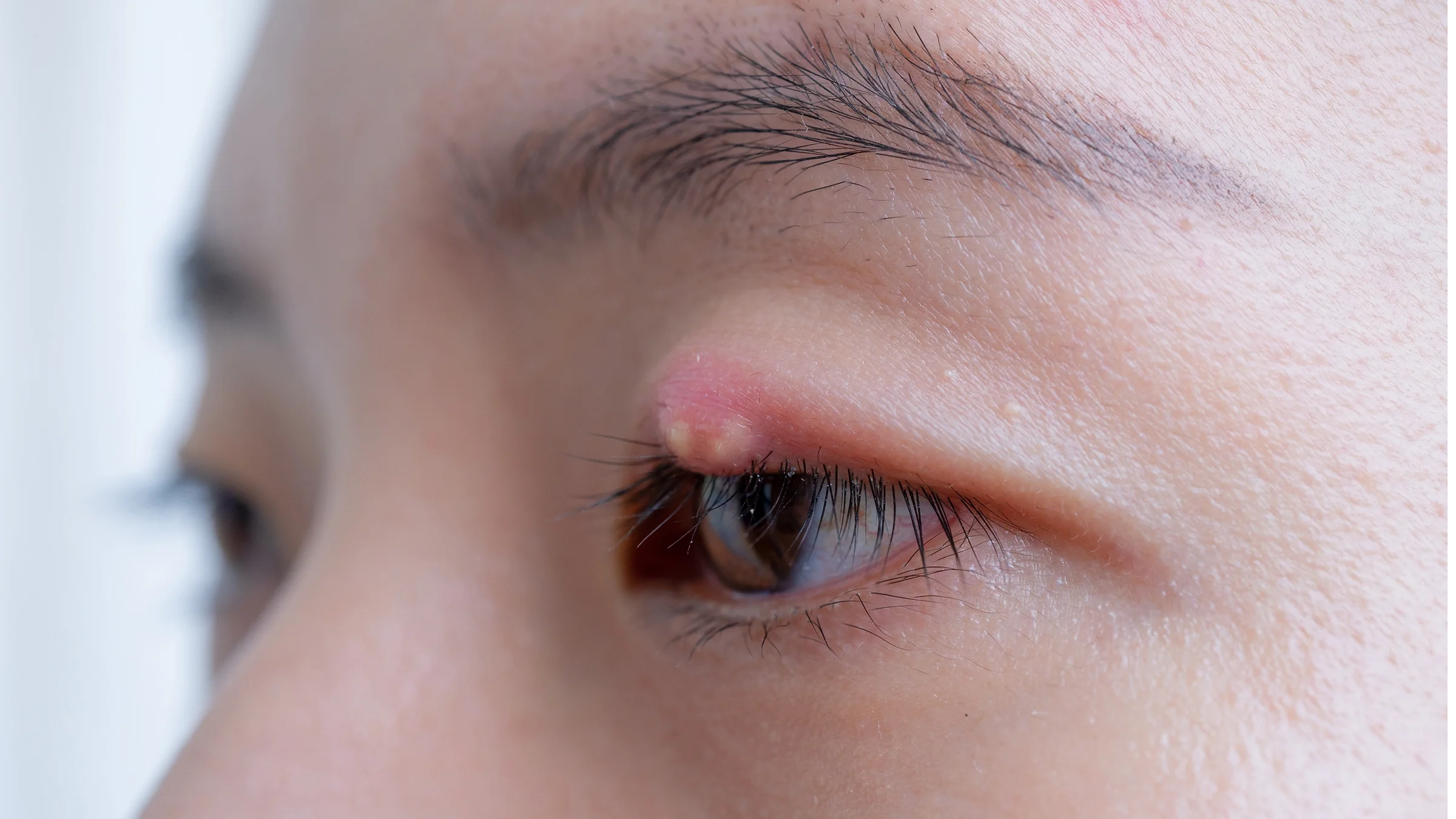 A close-up shot of a person with a cyst or growth on their eyelid.