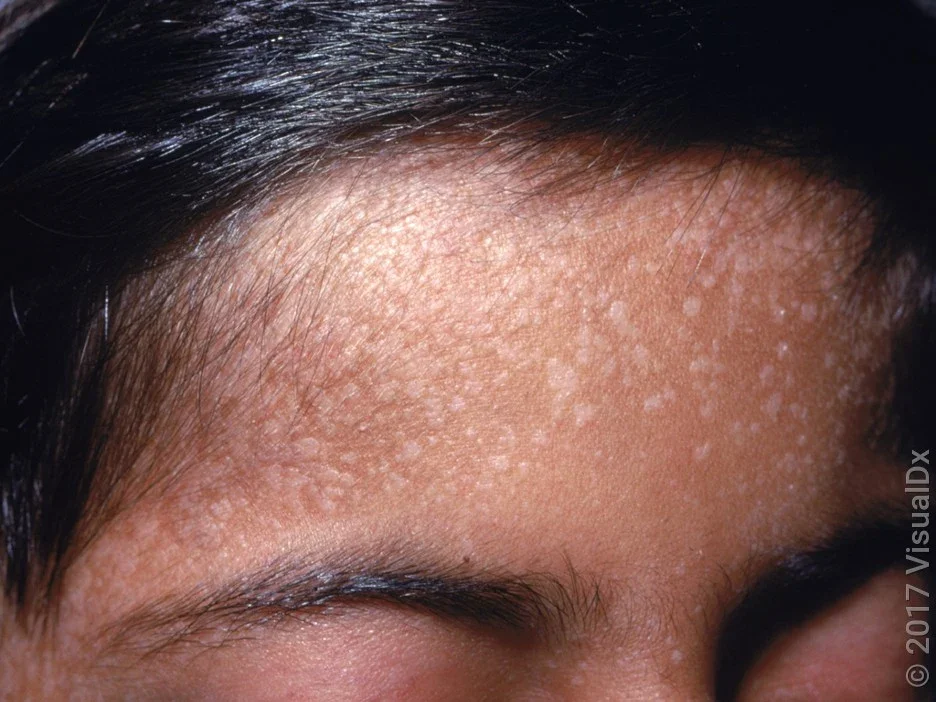 In darker skin tones, flat warts can be lighter in color than surrounding skin. 