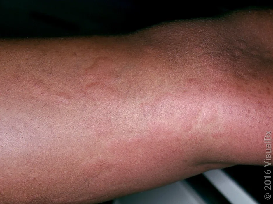 A person’s thigh covered in welts (hives).