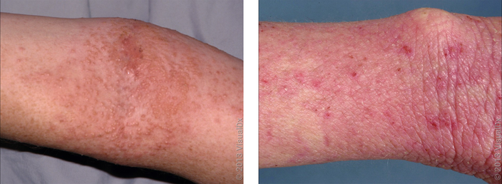 Left: Close-up of an arm with pink and red bumps and patches from eczema. Right: Close-up of an arm with thickened pink skin that’s been scratched in eczema. 