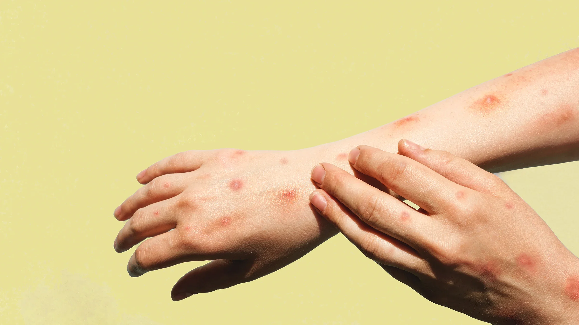 Close-up on someone’s hands and arms with monkeypox marks on a solid yellow background.
Marina Demidiuk/iStock via Getty Images