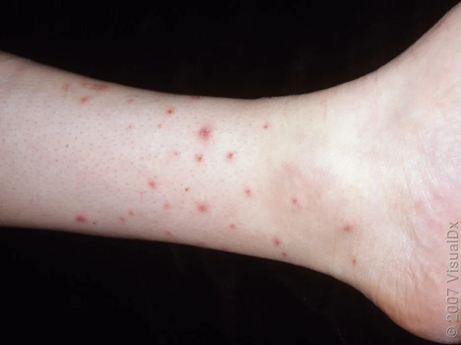 Close-up of the lower leg with many small red bumps from flea bites.