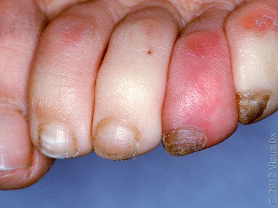 Close-up of Raynaud’s phenomenon on the toes. 