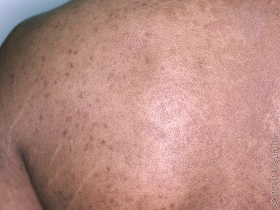 Close-up of fungal acne on the back and shoulder. 