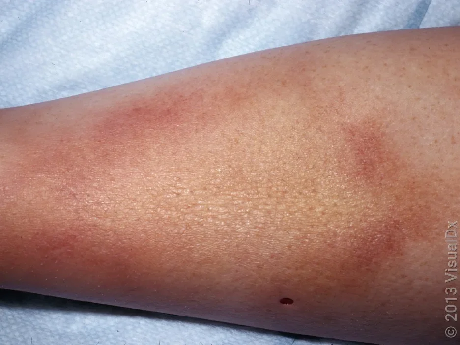 Close-up of a shin with Lyme disease, with a large, round, brown patch with lighter brown in the center. 