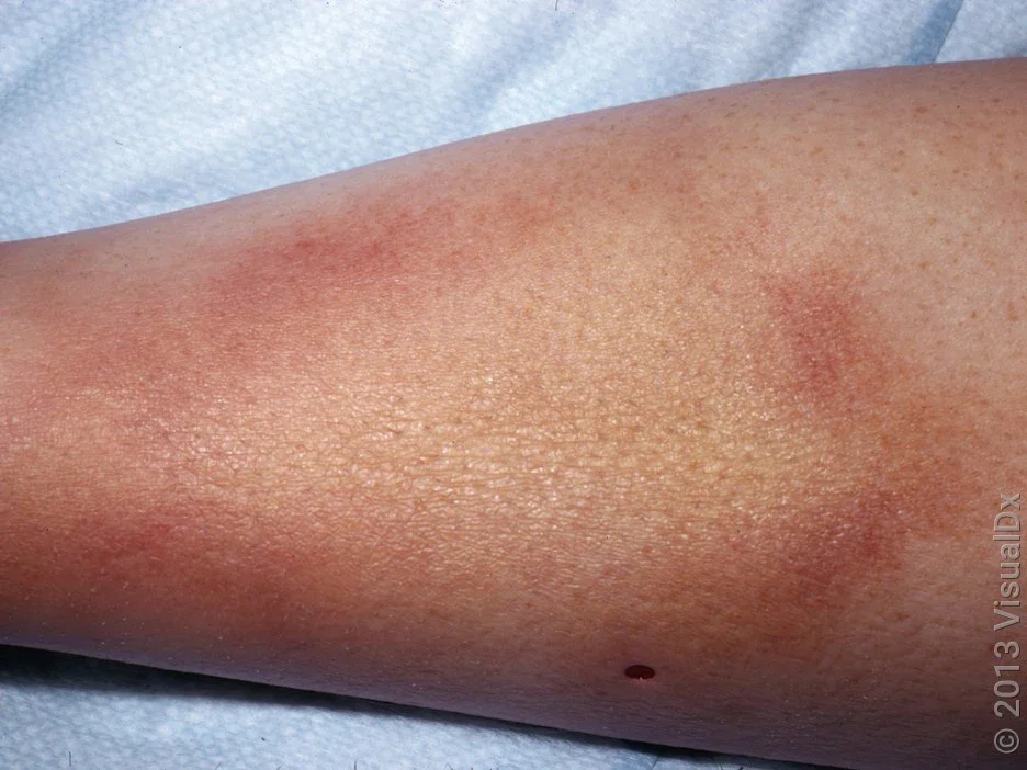 Close-up of a shin with Lyme disease, with a large, round, brown patch with lighter brown in the center. 