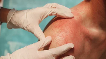Dermatology: closeup man shoulder rash 1327181307