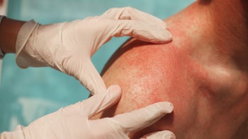 Dermatology: closeup man shoulder rash 1327181307